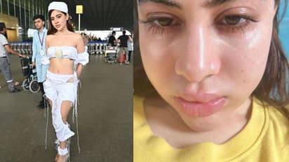 "சர்ச்சை டிரஸ்" நாயகிக்கு என்ன ஆச்சு.. வீங்கிய முகத்துடன் Urfi Javed - ரசிகர்களுக்கு அவர் கொடுத்த விளக்கம்!