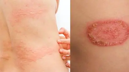 सेक्शुअली ट्रांसमिटेड इंफेक्शन से दाद जैसा निशान, सेक्स से फैलने इस रेयर बीमारी से हो जाए सावधान