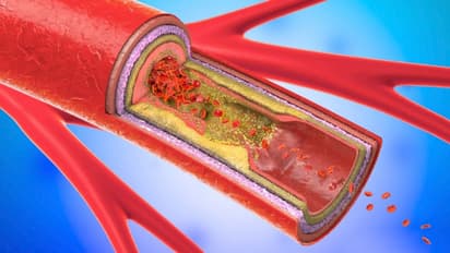 ഒരു മാസം കൊണ്ട് കൊളസ്ട്രോൾ കുറയ്ക്കാം; ചെയ്യേണ്ട കാര്യങ്ങള്‍ 