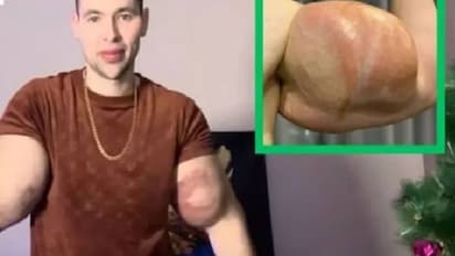 കൈകാലുകളിലെ മസിൽ പെരുപ്പിക്കാൻ 6 ലിറ്റർ വാസ്‍ലിൻ കുത്തിവച്ച് യുവാവ്