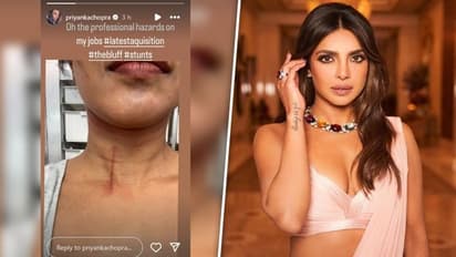 Priyanka Chopra gets injured while filming stunt, shares image of huge cut on her throat 