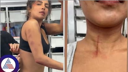 ನಟಿ ಪ್ರಿಯಾಂಕಾ ಚೋಪ್ರಾಗೆ ಶೂಟಿಂಗ್ ಸ್ಪಾಟ್‌ನಲ್ಲಿ ಗಾಯ; ರಕ್ತಸಿಕ್ತ ಘಟನೆ ಬಗ್ಗೆ ಮಾಹಿತಿ ಬಿಚ್ಚಿಟ್ಟ ನಟಿ