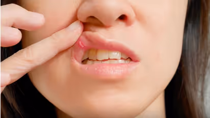 ഇടയ്ക്കിടെ വായ്പ്പുണ്ണ് വരാറുണ്ടോ?  എങ്കില്‍, ഡയറ്റില്‍ നിന്ന് ഒഴിവാക്കണം ഈ ഭക്ഷണങ്ങള്‍