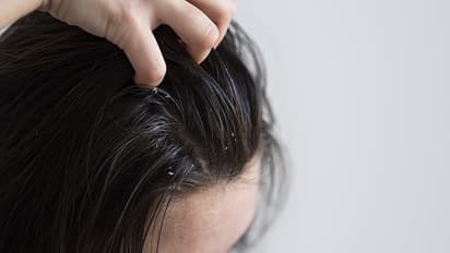 ఈ ఒక్కటి పెట్టినా నెత్తిమీద చుండ్రు ఉండదు.. వెంట్రుకలు రాలవు