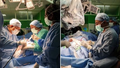 രാജ്യത്ത് തന്നെ അപൂര്വമായ ശസ്ത്രക്രിയ, കോഴിക്കോട് മെഡിക്കല് കോളേജിൽ വിജയം; 3 കുട്ടികൾ കേള്വി ലോകത്തേക്ക്