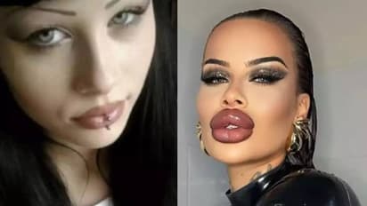 'നാശത്തിലേക്കാണ് നിന്റെ പോക്കെ'ന്ന് കൂട്ടുകാർ, 'വിചിത്രരൂപി'യെന്ന് കമന്റുകൾ; കോസ്മെറ്റിക് സർജറിക്കടിമയായ യുവതി