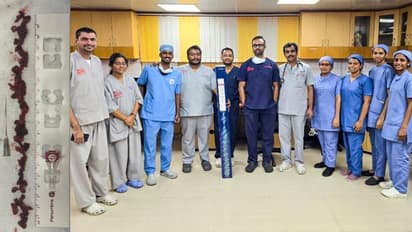 ശ്വാസകോശ ധമനികളിൽ രക്തം അടിയും, മരണംവരെ സംഭവിക്കാവുന്ന അവസ്ഥ, പൾമനറി എംബോളിസത്തിന് എഐ സഹായത്തിൽ ചികിത്സ വിജയം