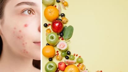 रिचर्स: एक्ने या पिंपल के लिए Special Diet लेने से क्या होता है असर?