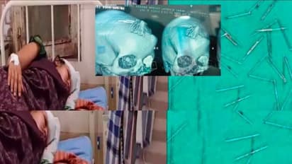 ಯುವತಿಯ ತಲೆ ಹೊಕ್ಕಿದ್ದ 70 ಸೂಜಿಗಳ ಶಸ್ತ್ರಚಿಕಿತ್ಸೆ ನಡೆಸಿ ಹೊರತೆಗೆದ ವೈದ್ಯರು