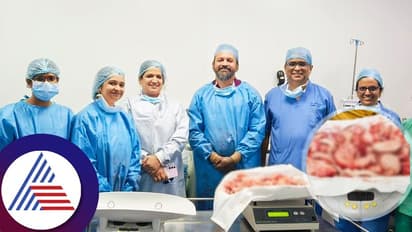 ದಕ್ಷಿಣ ಭಾರತದಲ್ಲೇ ಆಸ್ಟರ್ ಆರ್ವಿ ಆಸ್ಪತ್ರೆ ಮಹಾಸಾಧನೆ, ಲ್ಯಾಪ್ರೋಸ್ಕೋಪಿ ಮೂಲಕ 4 ಕೆಜಿ ತೂಕದ ಫೈಬ್ರಾಯ್ಡ್ ತೆಗೆದ ವೈದ್ಯರು!