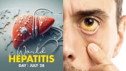 Health Tips: ഇന്ന് ലോക ഹെപ്പറ്റൈറ്റിസ് ദിനം; അറിയാം മഞ്ഞപ്പിത്തത്തിന്റെ ലക്ഷണങ്ങള്