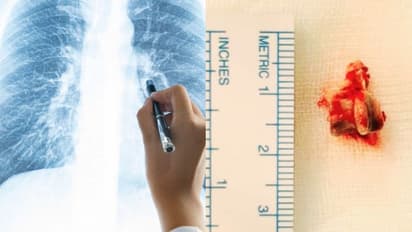 3 വർഷമായി മാറാത്ത ചുമ, 62കാരന്റെ ശ്വാസകോശത്തിൽ നിന്ന് കണ്ടെത്തിയത് കോഴിക്കറിയിലെ എല്ല് 