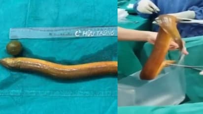 അതികഠിനമായ വയറുവേദന; ആശുപത്രിയിലെത്തിയ 31കാരനെ പരിശോധിച്ച ഡോക്ടർമാർക്ക് വരെ ആശ്ചര്യം, അകത്തുള്ളത് ജീവനുള്ള ഈൽ!