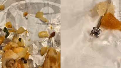 പുറത്ത് നിന്നും വാങ്ങിയ ഭക്ഷണം കഴിക്കുന്നതിനിടെ തൊണ്ടയിൽ തടസം, പരിശോധനയിൽ കണ്ടെത്തിയത് കല്ല് വച്ച മൂക്കുത്തി