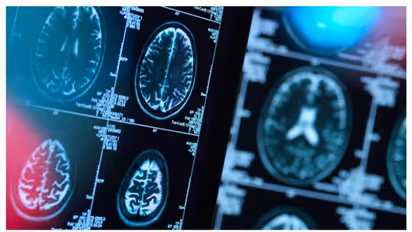 സാധാരണയെക്കാള് കൂടുതല് വേഗത്തിലുള്ള മസ്തിഷ്ക കോശങ്ങളുടെ വളര്ച്ച ഓട്ടിസത്തിന് കാരണമാകും ; പഠനം