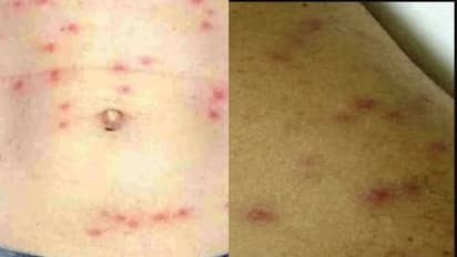 നീണ്ട പനി-തലവേദനയും കണ്ണുചുവപ്പും, ചുവന്ന തടിപ്പോ ലക്ഷണങ്ങൾ, വേണം ഗൗരവമായ ശ്രദ്ധ, ജാഗ്രതയോടെ തടയാം ചെള്ള് പനി