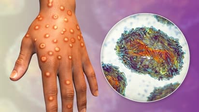 മുഖത്തും കൈപ്പത്തിയിലും ചുവന്ന പാടുകളും കുമിളകളും, ഈ ലക്ഷണങ്ങളുണ്ടേൽ ഉടൻ അറിയിക്കണം; എം പോക്സ് മുന്നറിയിപ്പ്