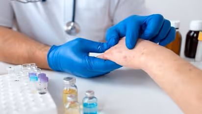 First suspected case of Mpox in India: Man under isolation, ministry says no cause of concern