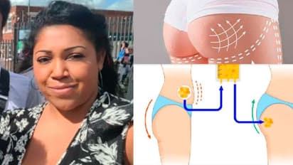 ಟರ್ಕಿಯಲ್ಲಿ ಬಟ್ ಲಿಫ್ಟ್ ಶಸ್ತ್ರಚಿಕಿತ್ಸೆ ವೇಳೆ ಮಹಿಳೆ ಸಾವು: ಶವದಿಂದ ಅಂಗಾಂಗ ಮಾಯ