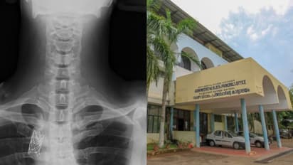 രക്തക്കുഴൽ വീര്‍ത്തുപൊട്ടി മരണം വരെ സംഭവിക്കുന്ന 'അന്യൂറിസം'; കോട്ടയം മെഡിക്കൽ കോളേജിൽ നൂതന ശസ്ത്രക്രിയ വിജയം