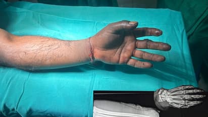 Shivamogga: ತುಂಡಾದ ಕೈಯನ್ನು ಯಶಸ್ವಿಯಾಗಿ ಮರುಜೋಡಿಸಿದ ‘ಸರ್ಜಿ’ ವೈದ್ಯರು: ಎರಡೂ ಕೈಗಳಿಗೆ ಮರುಜೀವ