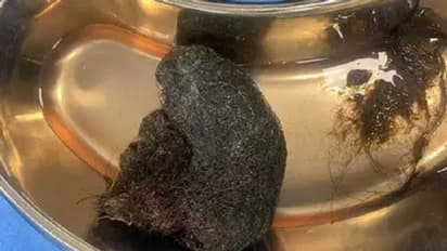 Bengaluru: ಎಂಟು ವರ್ಷದ ಬಾಲಕಿಯ ಹೊಟ್ಟೆಯಿಂದ ಕ್ರಿಕೆಟ್‌ ಚೆಂಡಿನ ಗಾತ್ರದ ಕೂದಲ ಬಾಲ್‌ ಹೊರತೆಗೆದ ವೈದ್ಯರು!