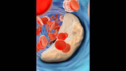 ಜಸ್ಟ್ 1 ರೂಪಾಯಿಯಿಂದ ಕೊಲೆಸ್ಟ್ರಾಲ್ ಕಡಿಮೆ ಮಾಡಿಕೊಳ್ಳಿ ; ಇಲ್ಲಿದೆ ಸರಳ ಟಿಪ್ಸ್!