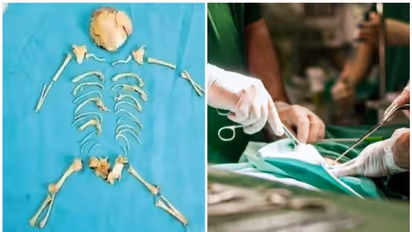 വയറ്റിൽ ആറ് മാസം പ്രായമുള്ള 'സ്റ്റോൺ ബേബി'; കടുത്ത വയറുവേദയുമായി എത്തിയ 27കാരിയിൽ കണ്ടെത്തിയത് അപൂർവ പ്രതിഭാസം