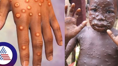 ಆಫ್ರಿಕಾದ 12 ದೇಶಗಳಲ್ಲಿ ಭಾರೀ ಅನಾಹುತ ಸೃಷ್ಟಿಸಿರುವ ಮಂಕಿಪಾಕ್ಸ್ ಭಾರತಕ್ಕೂ ಪ್ರವೇಶ?