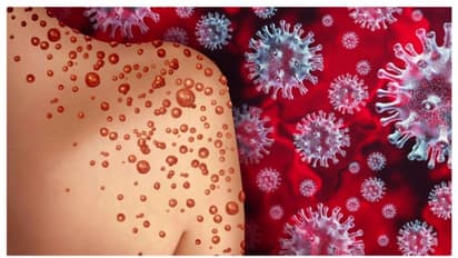 Kerala: 38-year-old man under observation for suspected Mpox symptoms in Malappuram