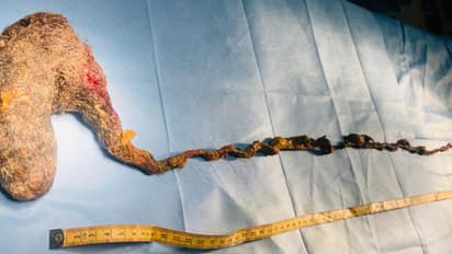 9 വയസുകാരിക്ക് അപൂർവ രോഗം, ആമാശയത്തിൽ 127 സെമി നീളത്തിൽ 'ഹെയർ ബോൾ'; പുതു ജീവനേകി ആലപ്പുഴ മെഡിക്കൽ കോളേജ്