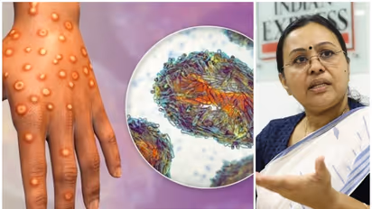 കേരളത്തിൽ എം പോക്സ് സ്ഥിരീകരിച്ചു; മലപ്പുറം സ്വദേശിക്ക് രോഗം; വിദേശത്ത് നിന്നും വന്നവർക്ക് കർശന നിർദ്ദേശങ്ങൾ