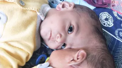 Pakistani conjoined twins separated after 14-hr operation, UK surgeon dubs recovery as 'excellent' | SEE PICS