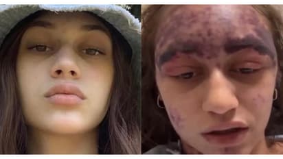 'വാക്സിനുകൾ സ്വീകരിച്ച് 10 മിനിറ്റിന് ശേഷം ഈ ഗതിയിലായി'; വീഡിയോ പങ്കുവെച്ച് യുവതി, ആശുപത്രിക്കെതിരെ ആരോപണം