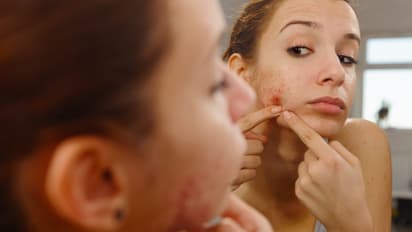  Effective Acne Treatments: Top solutions for clear skin and lasting results