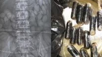 എക്സ്റേയിൽ എല്ലാം തെളിഞ്ഞു, യുവതിയുടെ വയറ്റിൽ കണ്ടത് 60ലേറെ കൊക്കെയ്ൻ കാപ്സ്യൂളുകൾ, അറസ്റ്റിൽ