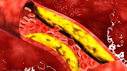 കൊളസ്ട്രോൾ കുറയ്ക്കാൻ വീട്ടില്‍ ചെയ്യേണ്ട ആറ് കാര്യങ്ങള്‍