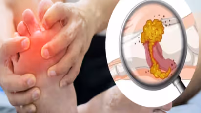 യൂറിക് ആസിഡിന്‍റെ അളവ് കുറയ്ക്കാന്‍ സഹായിക്കുന്ന എട്ട് പാനീയങ്ങള്‍   