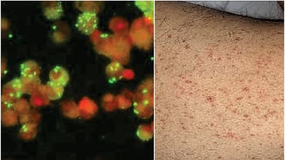 തിരുവനന്തപുരത്ത് മ്യൂറിൻ ടൈഫസ് സ്ഥിരീകരിച്ചു, വിദേശത്ത് നിന്നെത്തിയ ആൾക്ക് രോഗം 