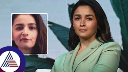 ಬೋಟಾಕ್ಸ್ ಸರ್ಜರಿಯಿಂದ ಆಲಿಯಾಗೆ ಪಾರ್ಶ್ವವಾಯು- ಮುಖ ಸೊಟ್ಟಗೆ? ನಟಿ ಹೇಳಿದ್ದೇನು?