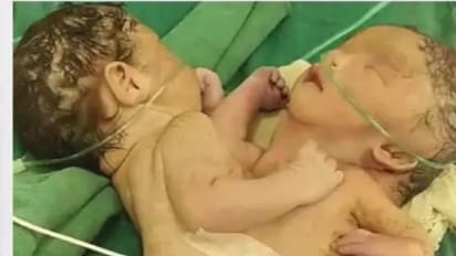 एक हृदय, दोन शरीर: शहडोलमध्ये अनोख्या बाळाचा जन्म