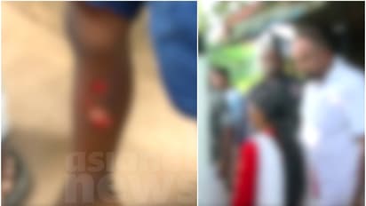 4 വയസുകാരനെ സ്പൂൺ ചൂടാക്കി പൊള്ളിച്ചെന്ന് പരാതി; അമ്മയ്ക്കെതിരെ പൊലീസ് കേസെടുത്തു