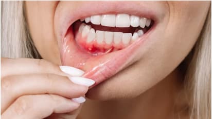 Health Tips: വായ്പ്പുണ്ണ് മാറാന് വീട്ടില് പരീക്ഷിക്കേണ്ട പത്ത് ടിപ്സ്