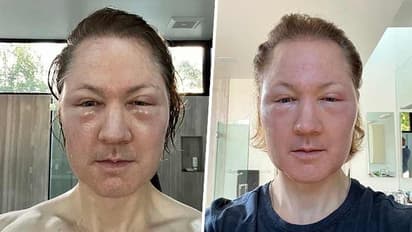 Biohacker Bryan Johnson's 'age-defying' treatment goes horribly wrong; shocking selfie shows extreme swelling