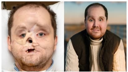 ആത്മഹത്യാശ്രമത്തിൽ തകർന്നത് മുഖം; ഒടുവിൽ, 10 വര്‍ഷത്തിന് ശേഷം പുതിയ മുഖവുമായി ജീവിതത്തിലേക്ക്