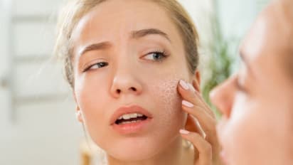5 Essential tips to prevent dry skin during winter and keep your skin hydrated