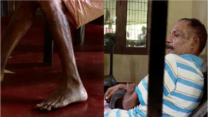 പഴുപ്പ് വന്ന് ശരീരം പൊട്ടിയൊലിക്കുന്നു; പ്രവാസം വഴിമുട്ടി, ഇപ്പോൾ നാട്ടിലും ജോലിയില്ല; രാമചന്ദ്രന് സഹായം വേണം