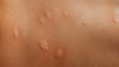 ആലപ്പുഴയിലെ സ്കൂളിൽ 27 വിദ്യാര്ത്ഥികൾക്ക് കൂട്ടത്തോടെ ചൊറിച്ചിലും ദേഹാസ്വാസ്ഥ്യവും; സ്കൂളിന് അവധി നൽകി