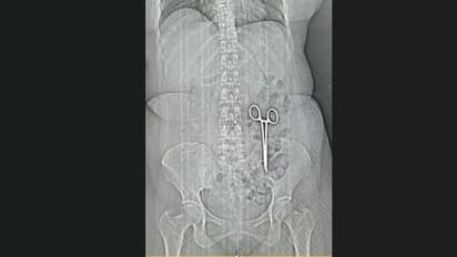 രണ്ട് വർഷമായി വിട്ടുമാറാത്ത വയറുവേദന, മരുന്നുകളൊന്നും ഫലിച്ചില്ല; സിടി സ്കാൻ ചെയ്തപ്പോൾ ഞെട്ടൽ, കണ്ടത് കത്രിക