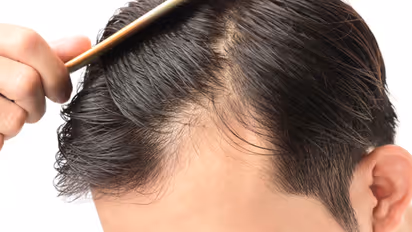 Whey Protein : முடி உதிர்தலுக்கு 'வே புரோட்டீன்' காரணமா? முழுத் தகவல்கள் இதோ!! 